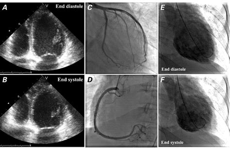 severe lv systolic impairment.